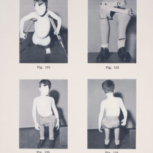 Four overexposed views show a child with a blurred face, a curved spine, and one leg fitted with a prosthetic as they try it on.